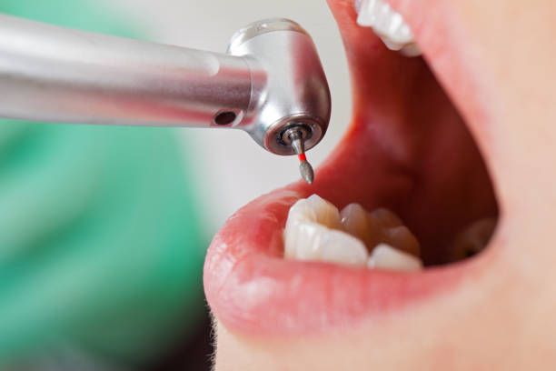 Best Emergency Wisdom Tooth Extraction in Elkins, WV